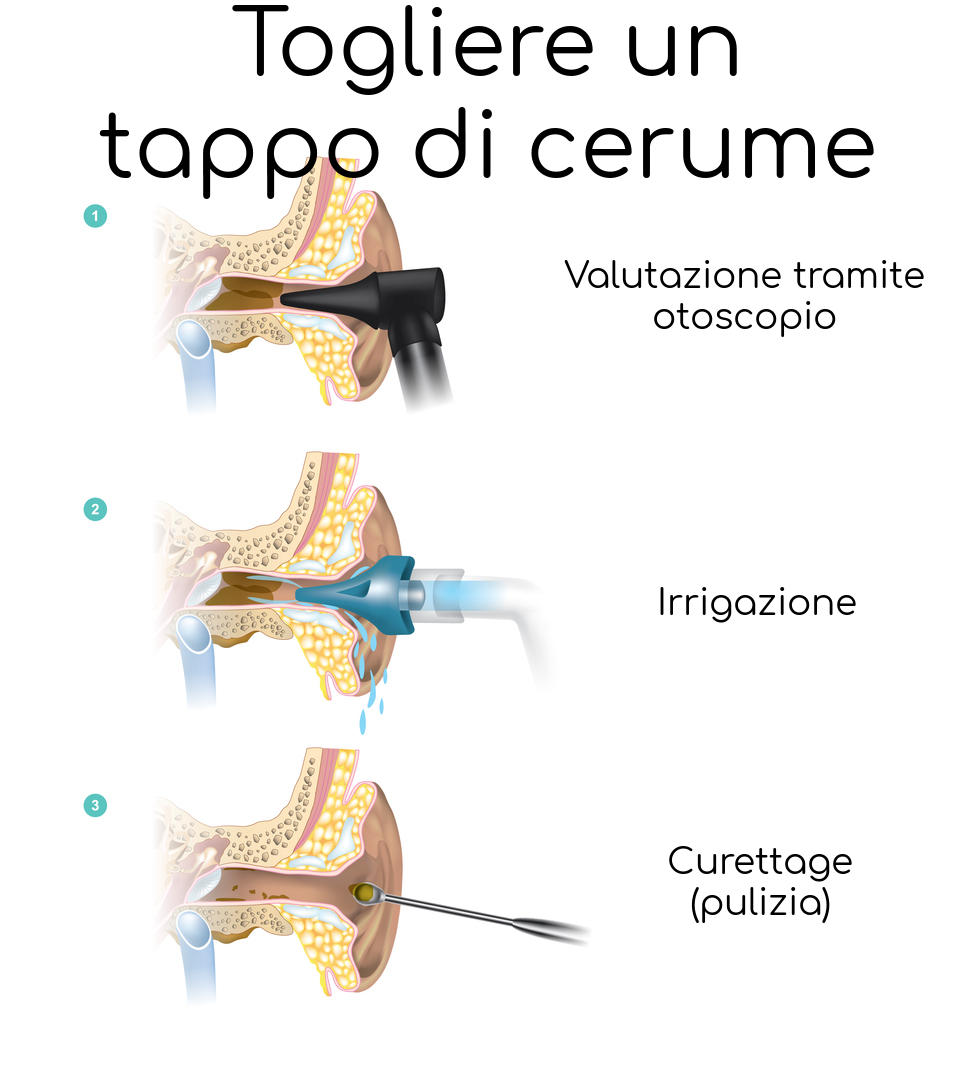 Processo diagnostico e terapeutico dei tappi di cerume