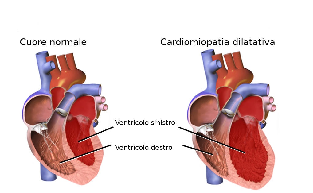 Rappresentazione grafica delle differenze tra un cuore sano e uno affetto da cardiomiopatia dilatativa