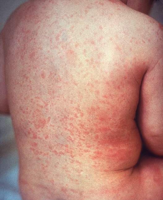 Schiena di bambino affetto da rosolia