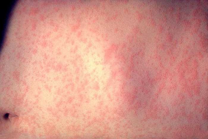 Pelle colpita dall'esantema del morbillo