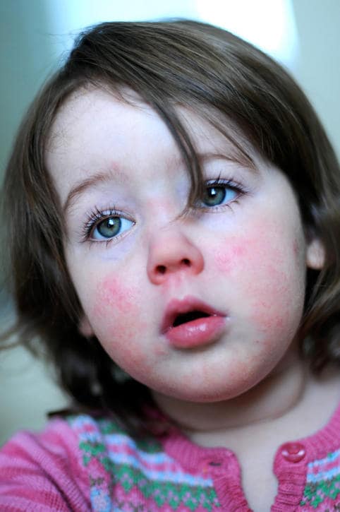 Fotografia di una bambina colpita da scarlattina