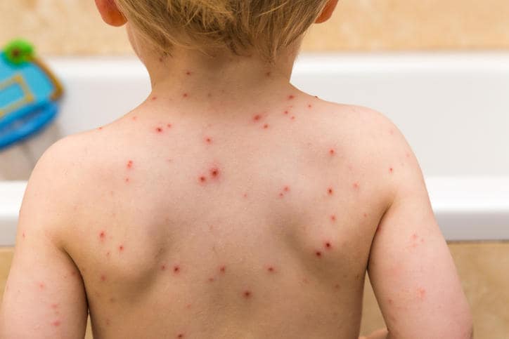 Schiena di un bimbo affetto da varicella