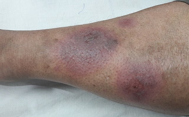 Primo piano delle lesioni dell'eritema nodoso