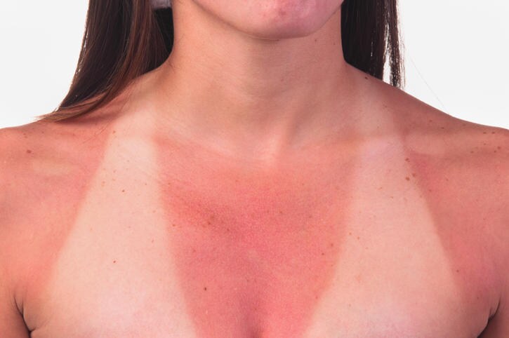 Eritema solare sul petto di una donna