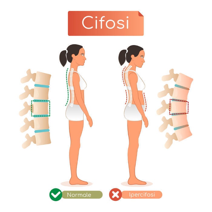 Rappresentazione schematica della cifosi in confronto a una postura normale
