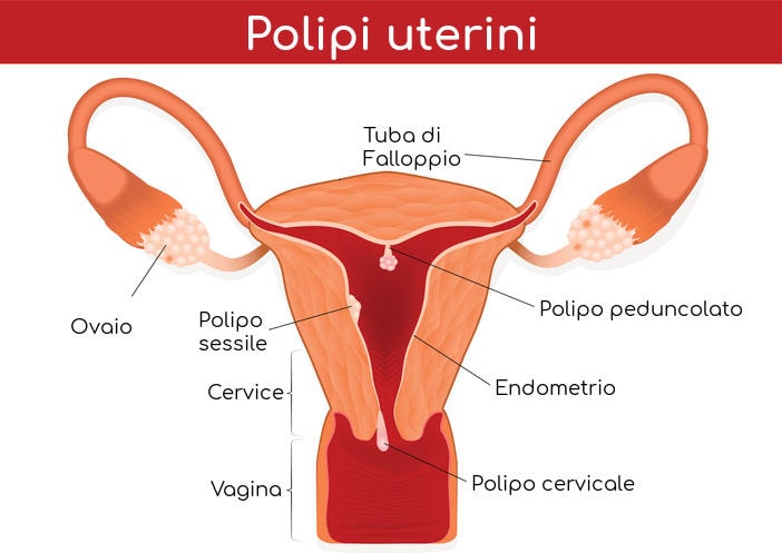 Rappresentazione grafica dell'anatomia dei polipi uterini