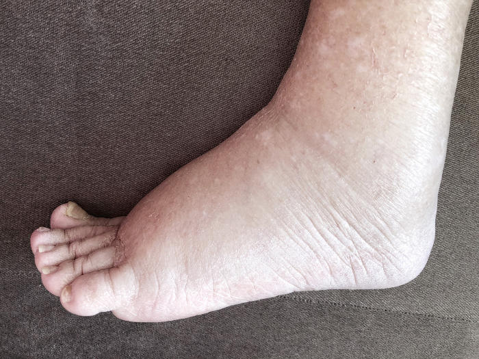 Fotografia di un edema alla caviglia