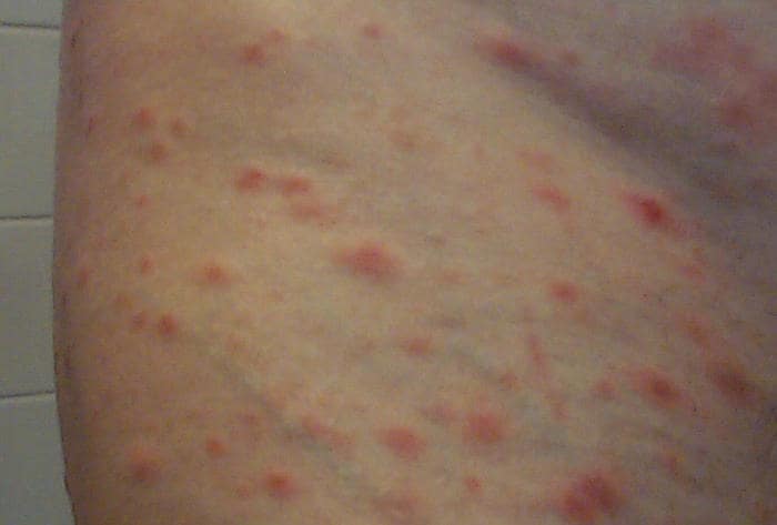 Fotografia di pitiriasi lichenoide