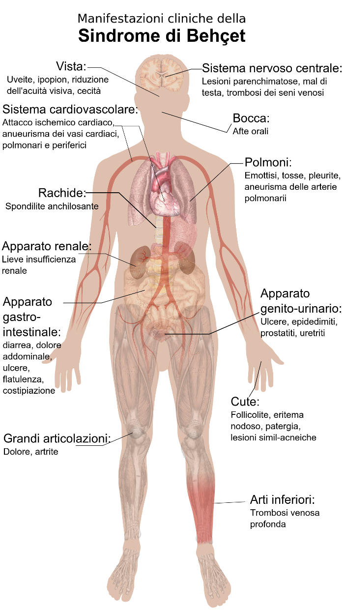 Riassunto grafico dei sintomi della sindrome di Behcet