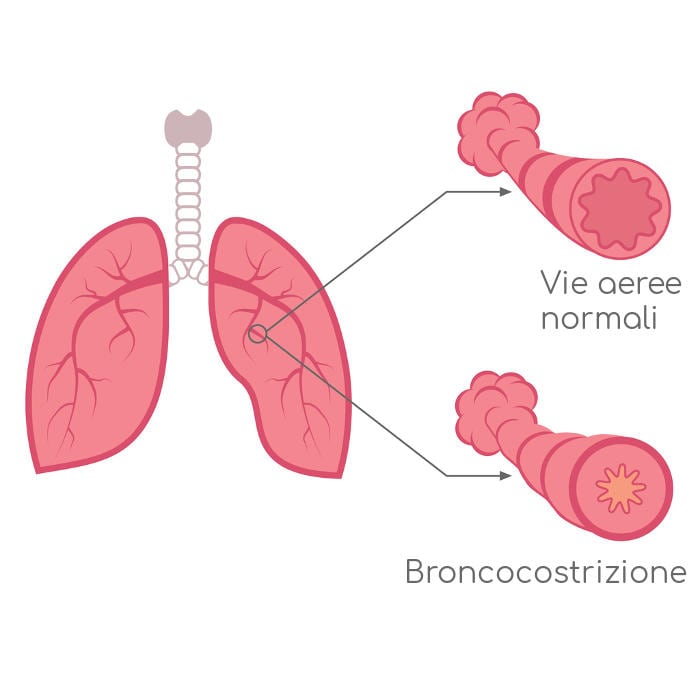Rappresentazione grafica dell'ostruzione e della costrizione dei bronchi