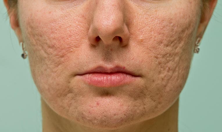 Primo piano di cicatrici da acne sul viso