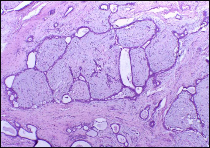 Fibroadenoma, analisi istopatologica
