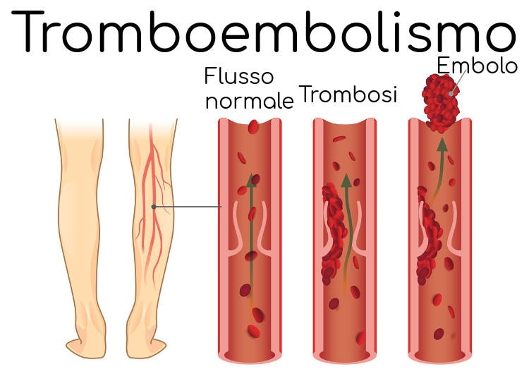 Meccanismo di trombosi e formazione di emboli
