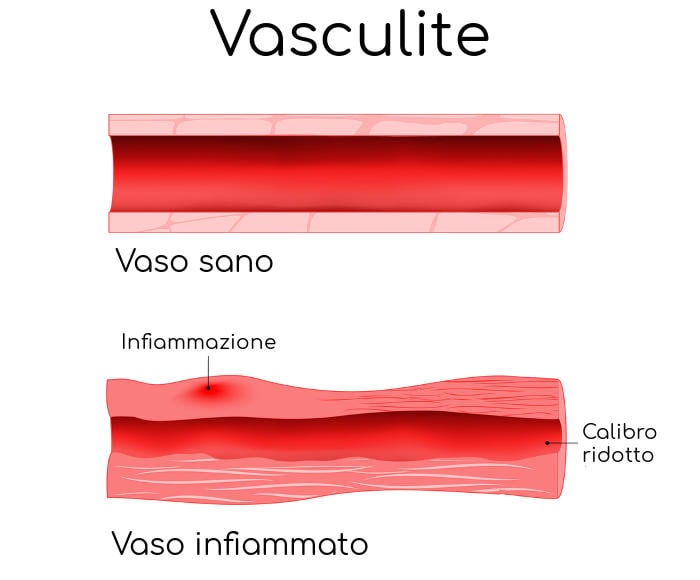 Semplificazione delle conseguenze della vasculite