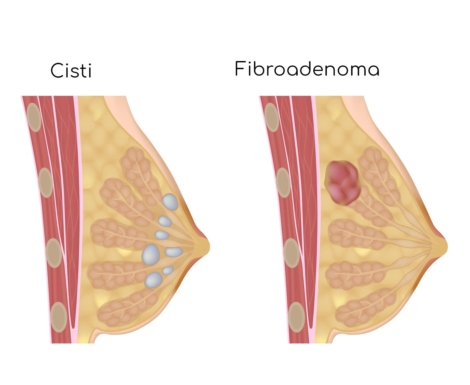 Fibroadenoma