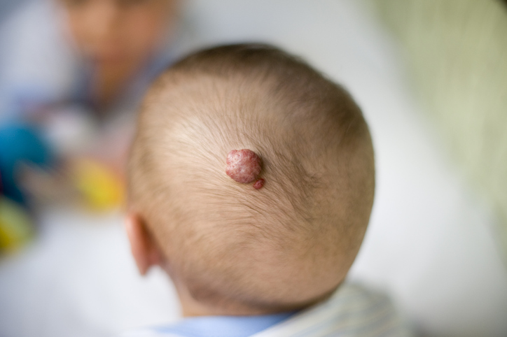 Fotografia di un emoangioma sulla testa di un neonato