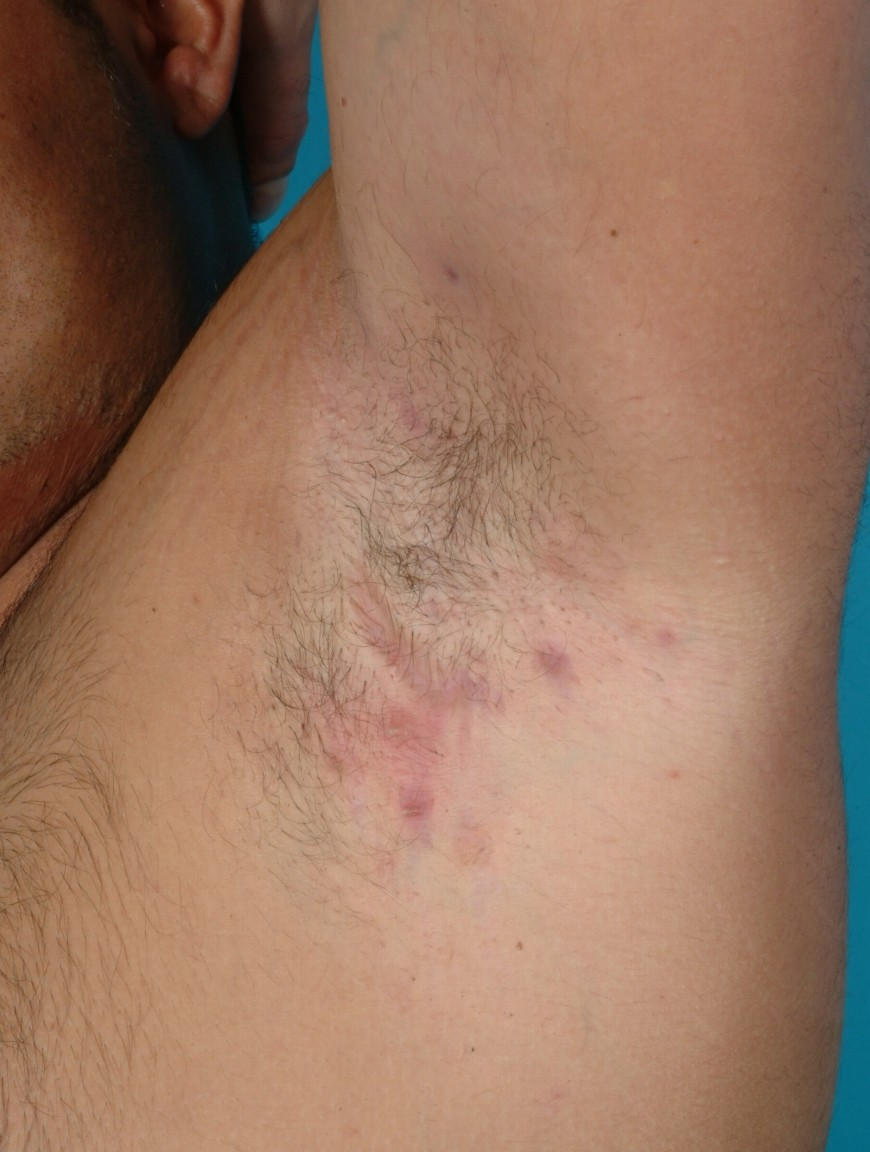 Fotografia di lesioni da idrosadenite supporativa sotto l'ascella