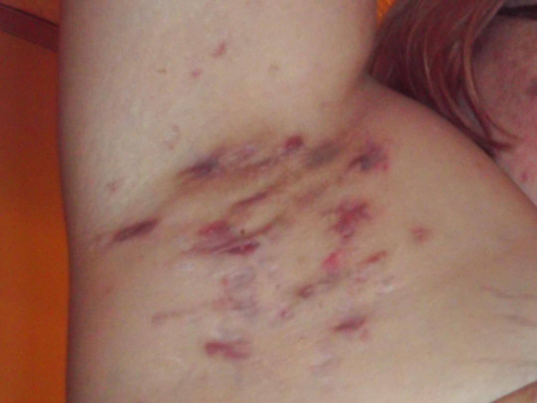 Fotografia di lesioni da idrosadenite supporativa sotto l'ascella di una donna