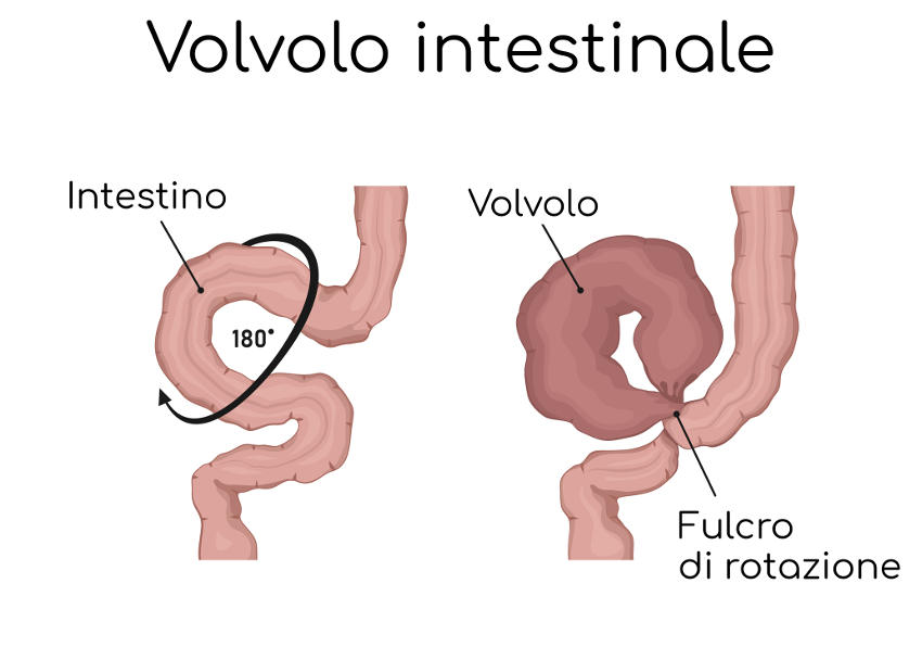 Rappresentazione grafica di un volvolo intestinale