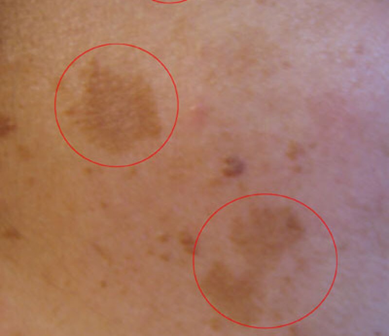 Ingrandimento delle macchie da melasma sul viso