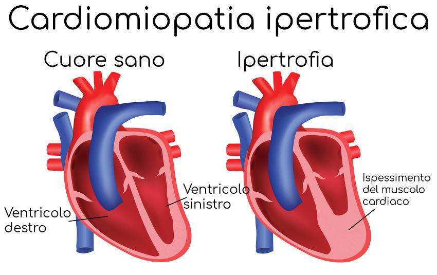 Rappresentazione schematica della cardiomiopatia ipertrofica