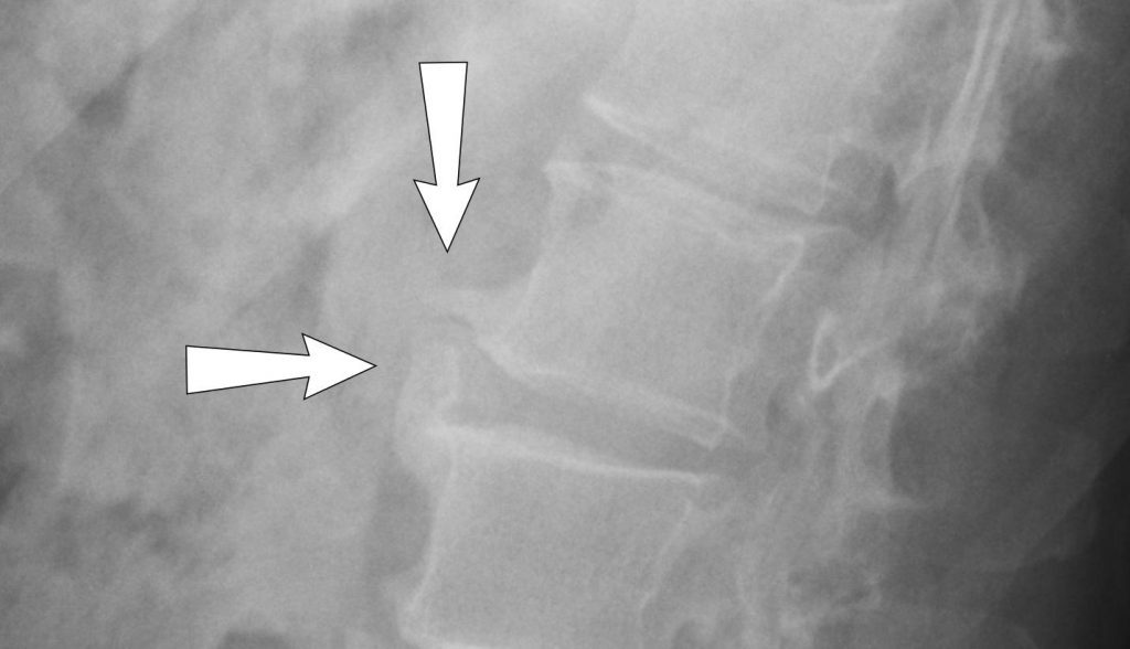 Radiografia di osteofiti lombari