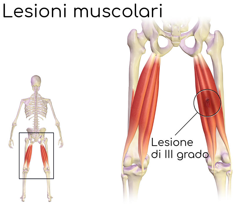 Lesione muscolare di terzo grado