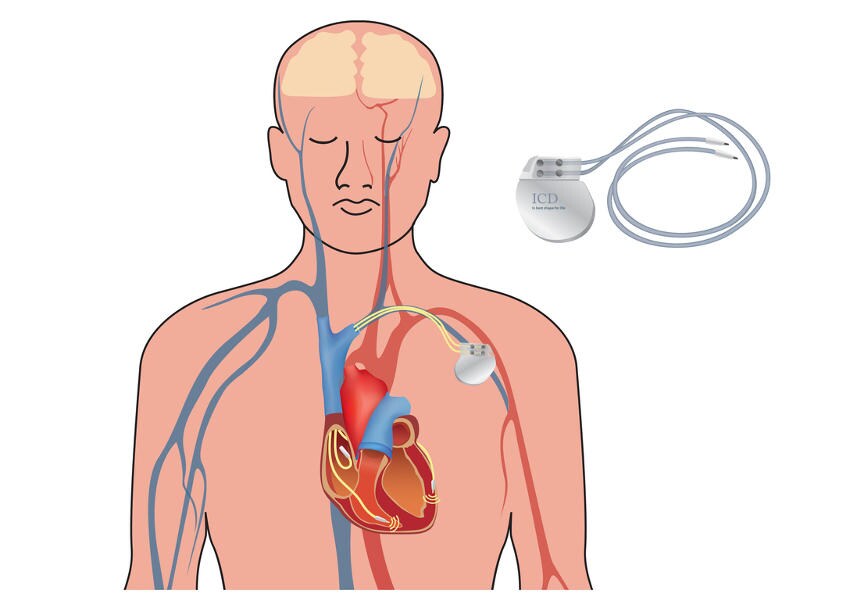 Schema del defibrillatore impiantabile