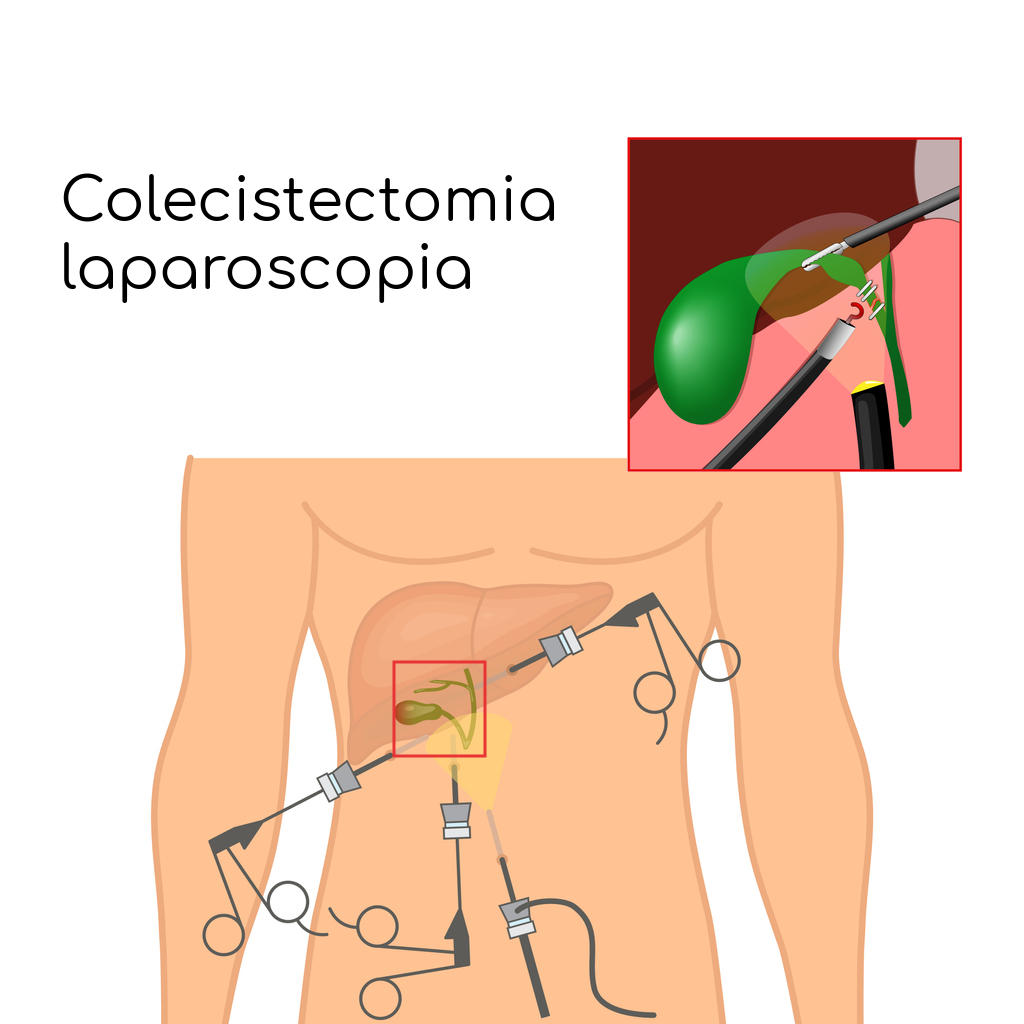 Esemplificazione della colecistectomia laparoscopica