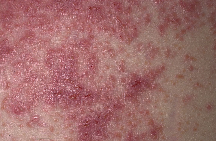 Ingrandimento delle lesioni da dermatite erpetiforme