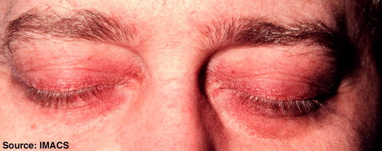 Edema ed eritema da dermatomiosite