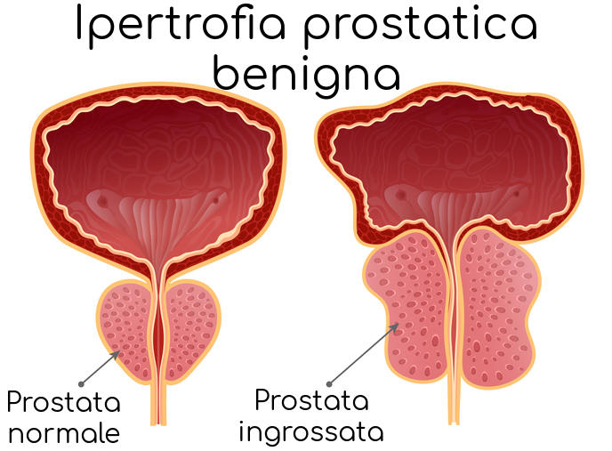 Ipertrofia prostatica benigna, semplificazione anatomica