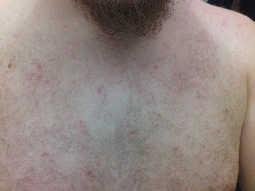 Miliaria rubra sul petto di un uomo