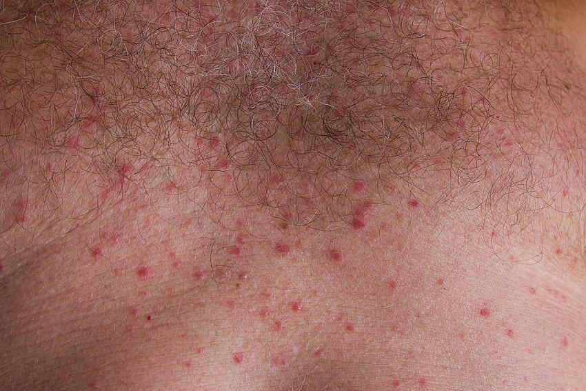 Miliaria sul petto