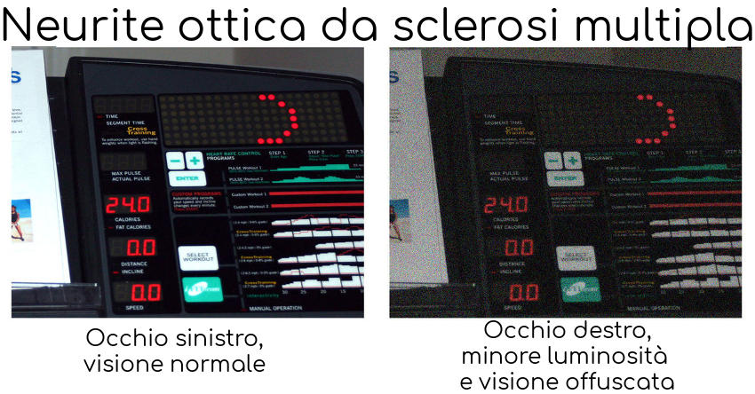Esempio di visione con neurite ottica
