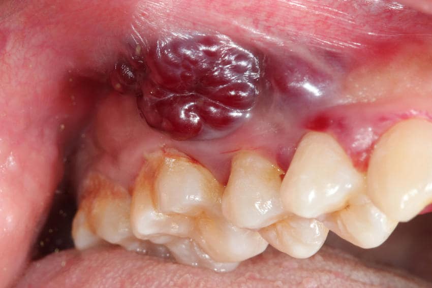 Sarcoma di Kaposi a livello orale