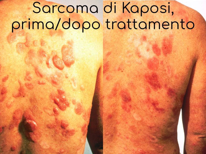 Sarcoma di Kaposi, prima e dopo trattamento con interferonre (1987)