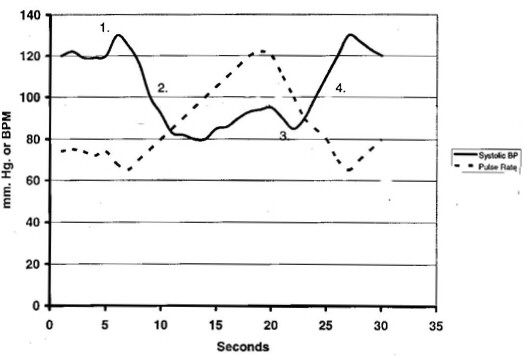 Grafico di pressione sanguigna e battiti cardiaci durante la manovra di Valsalva
