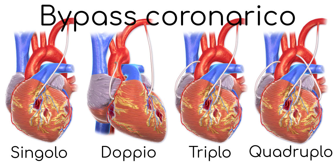 Esempio di bypass singolo, doppio, triplo e quadruplo