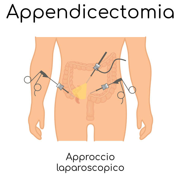 Schematizzazione dell'intervento di rimozione dell'appendice con laparoscopia