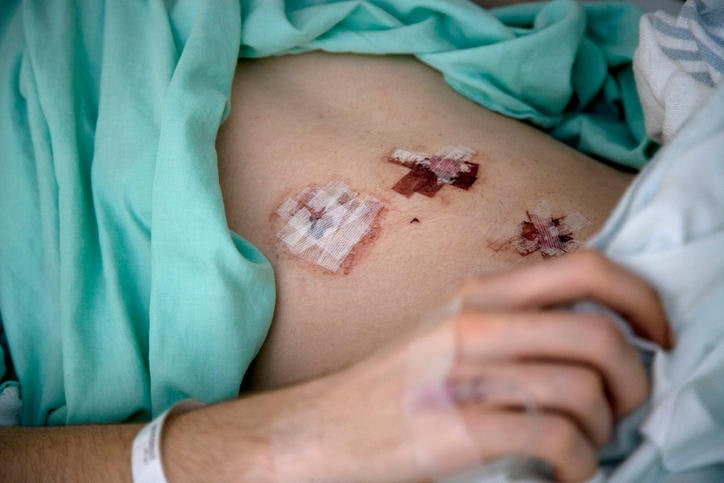 Ferite da laparoscopia dopo appedicectomia