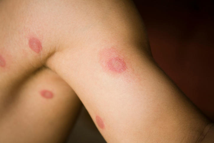 Tinea corporis sulla gamba di una donna