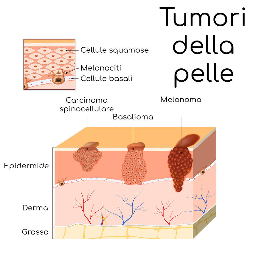Rappresentazione grafica dei principali tumori della pelle