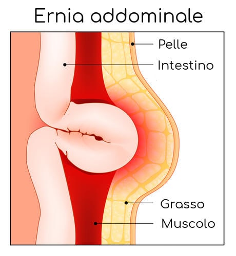 Schema semplificato di un'ernia addominale