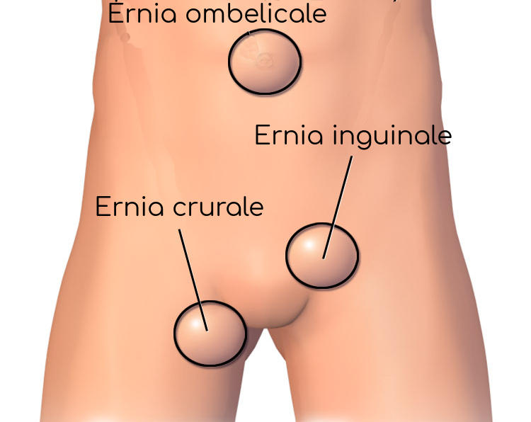 Ernie addominali