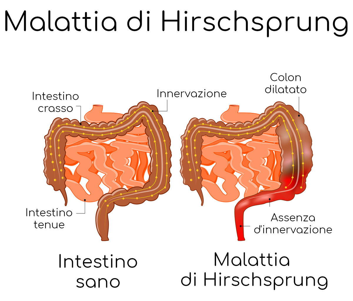 Semplificazione anatomica della malattia di Hirschsprung