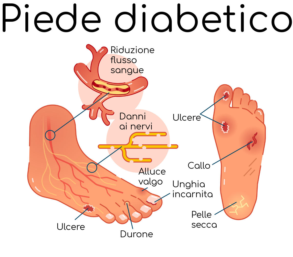 Schematizzazione del piede diabetico