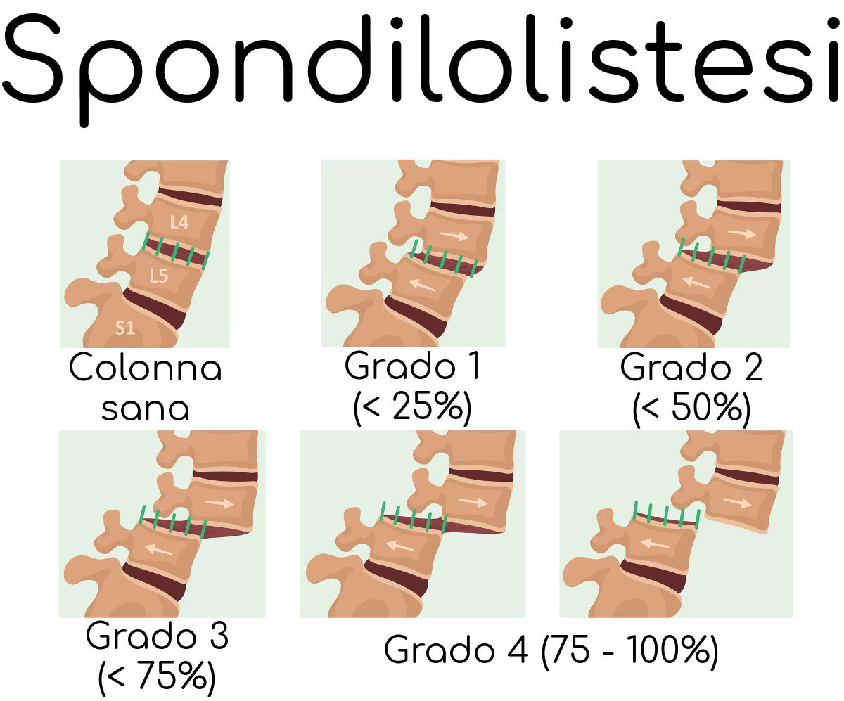 Rappresentazione grafica della gravità della spondilolistesi