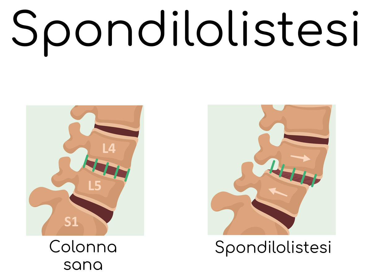 Spondilolistesi Rappresentazione grafica della Spondilolistesi