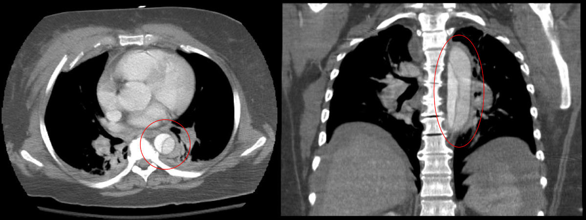 Dissezione aortica vista con TC